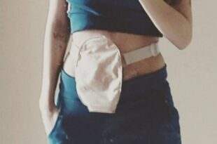 Ostomizados reclamam da baixa qualidade das bolsas distribuídas na Fundhacre que produzem vazamentos e irritação