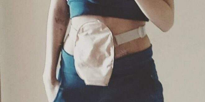 Ostomizados reclamam da baixa qualidade das bolsas distribuídas na Fundhacre que produzem vazamentos e irritação