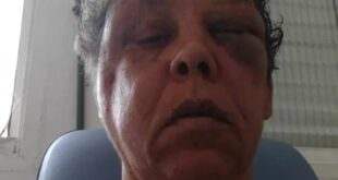 Mulher é agredida de forma brutal ao reagir a assalto no litoral de SP; VÍDEO