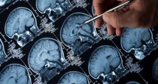 Pesquisa da UFMG desenvolve método para tratar câncer cerebral