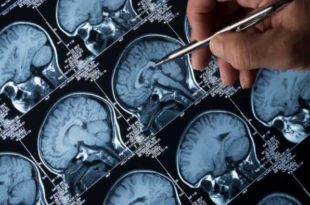 Pesquisa da UFMG desenvolve método para tratar câncer cerebral