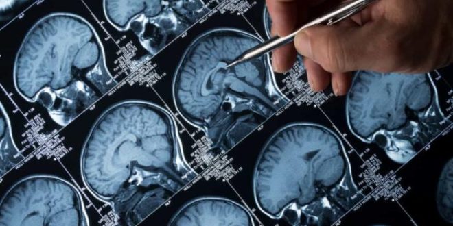 Pesquisa da UFMG desenvolve método para tratar câncer cerebral