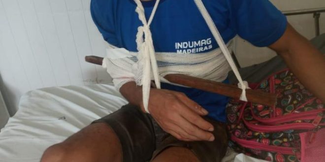 Funcionário de serraria de Sena Madureira sofre acidente de trabalho e fica com pedaço de madeira cravada no braço