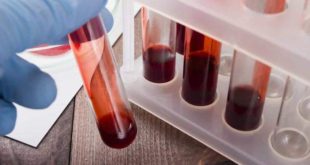 Novo exame de sangue pode ajudar no diagnóstico de Alzheimer