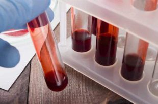 Novo exame de sangue pode ajudar no diagnóstico de Alzheimer