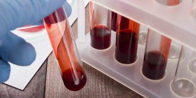 Novo exame de sangue pode ajudar no diagnóstico de Alzheimer