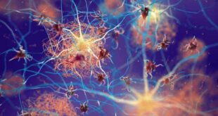 Estudo revela semelhanças entre Covid-19 prolongada e Alzheimer