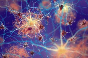 Estudo revela semelhanças entre Covid-19 prolongada e Alzheimer