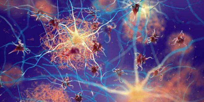 Estudo revela semelhanças entre Covid-19 prolongada e Alzheimer