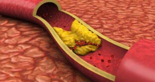 Colesterol alto é fator de risco para doenças cardiovasculares