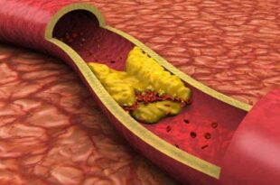 Colesterol alto é fator de risco para doenças cardiovasculares
