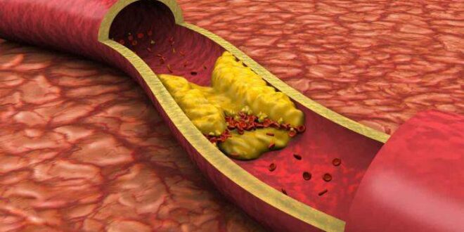 Colesterol alto é fator de risco para doenças cardiovasculares