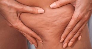Celulite piora com alimentação inflamatória; veja como prevenir