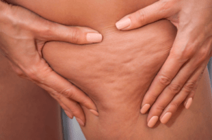Celulite piora com alimentação inflamatória; veja como prevenir