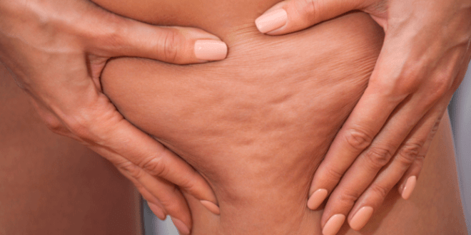 Celulite piora com alimentação inflamatória; veja como prevenir