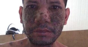 No Acre, homem com doença desconhecida pede ajuda para realizar tratamento
