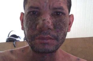 No Acre, homem com doença desconhecida pede ajuda para realizar tratamento