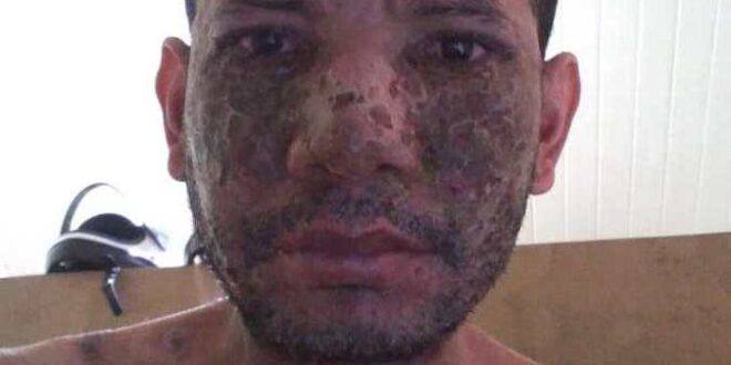 No Acre, homem com doença desconhecida pede ajuda para realizar tratamento
