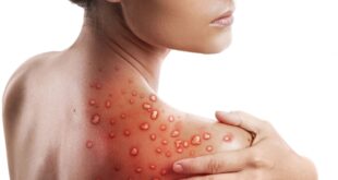 Saúde notifica caso suspeito de monkeypox