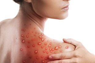 Saúde notifica caso suspeito de monkeypox