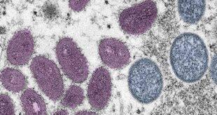 Saúde notifica caso suspeito de monkeypox no Acre