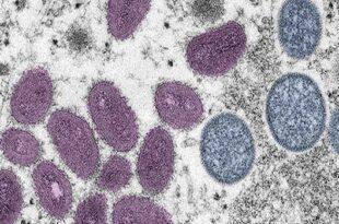 Saúde notifica caso suspeito de monkeypox no Acre