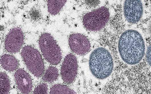 Saúde notifica caso suspeito de monkeypox no Acre