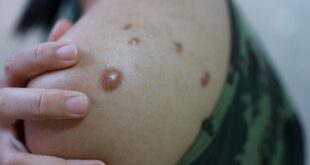 Sesacre notifica caso suspeito de monkeypox em Manoel Urbano