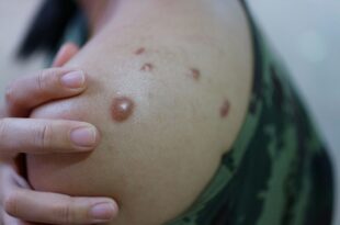 Sesacre notifica caso suspeito de monkeypox em Manoel Urbano