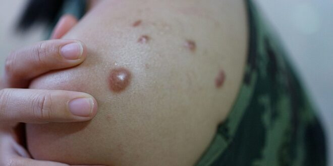 Sesacre notifica caso suspeito de monkeypox em Manoel Urbano