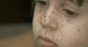 Saúde do Acre recebe 1.600 doses da vacina contra a catapora