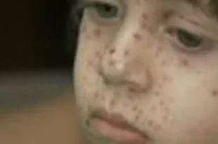 Saúde do Acre recebe 1.600 doses da vacina contra a catapora