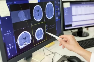Covid-19 pode ter efeitos semelhantes à esquizofrenia e aumentar risco de diabetes