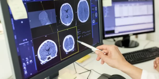 Covid-19 pode ter efeitos semelhantes à esquizofrenia e aumentar risco de diabetes