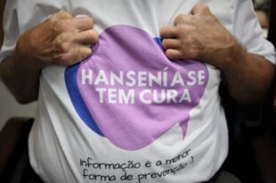 Tarauacá passa a realizar análise local para detecção de hanseníase