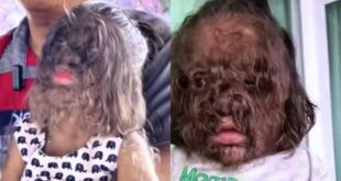 Bebês nascem com 'Síndrome do lobisomem' após pais usarem loção para calvície