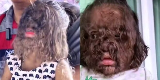 Bebês nascem com 'Síndrome do lobisomem' após pais usarem loção para calvície