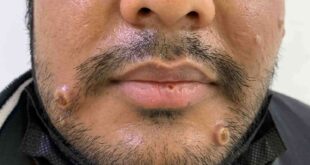 No vizinho: Amazonas registra 74 casos confirmados de mpox
