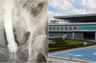 Bizarro: homem é hospitalizado com objeto de quase 1 metro introduzido no ânus