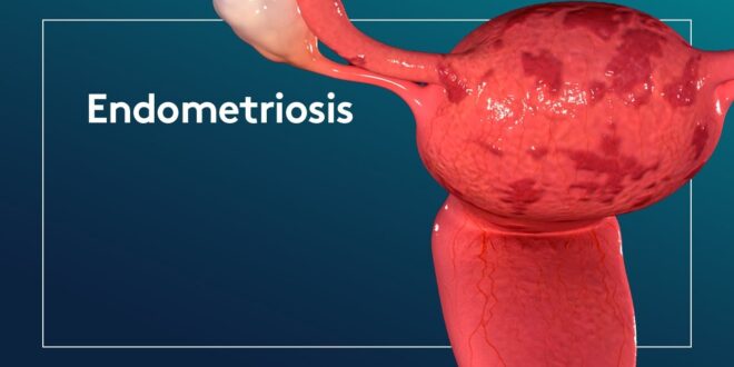 Acre lança ambulatório especializado no tratamento da endometriose