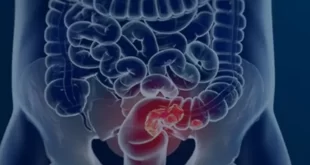 Bem viver: conheça o alimento que reduz o risco de câncer de intestino