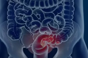 Bem viver: conheça o alimento que reduz o risco de câncer de intestino