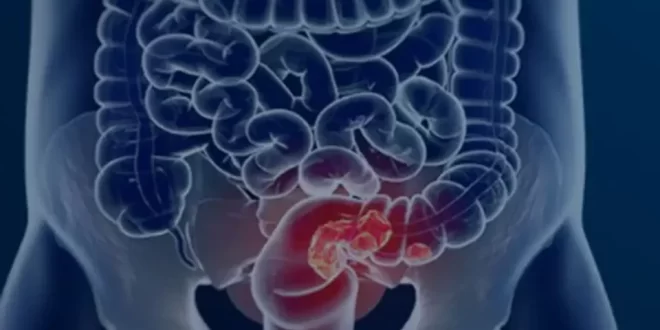 Bem viver: conheça o alimento que reduz o risco de câncer de intestino