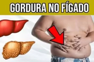 Bem Viver: como a gordura se acumula no fígado e onde ela se instala no órgão