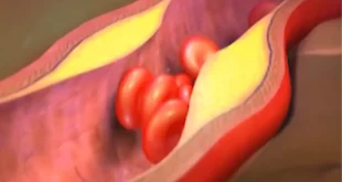 Bem Viver: cardiologista aponta os piores hábitos que entopem as artérias