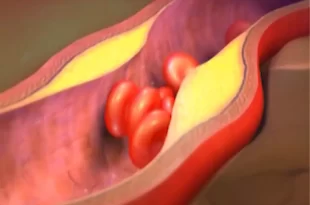 Bem Viver: cardiologista aponta os piores hábitos que entopem as artérias