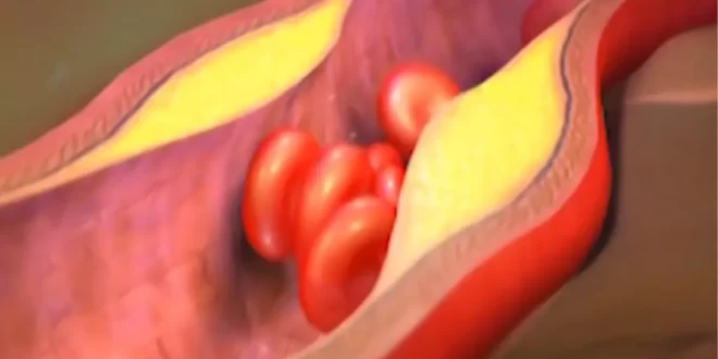 Bem Viver: cardiologista aponta os piores hábitos que entopem as artérias
