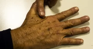 Tumor maligno mais incidente no Brasil é o de pele não melanoma