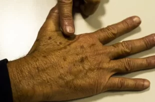 Tumor maligno mais incidente no Brasil é o de pele não melanoma