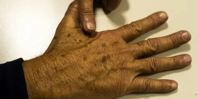 Tumor maligno mais incidente no Brasil é o de pele não melanoma